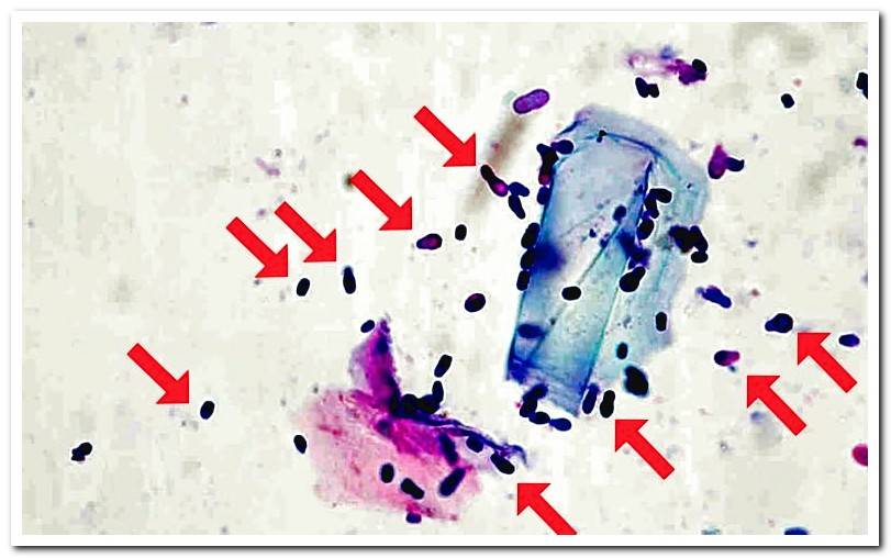 Yeast-Malassezia-under-the-microscope