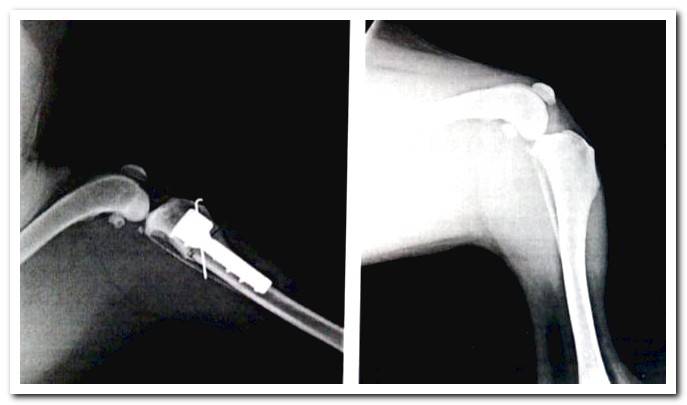 TTA femur radiography