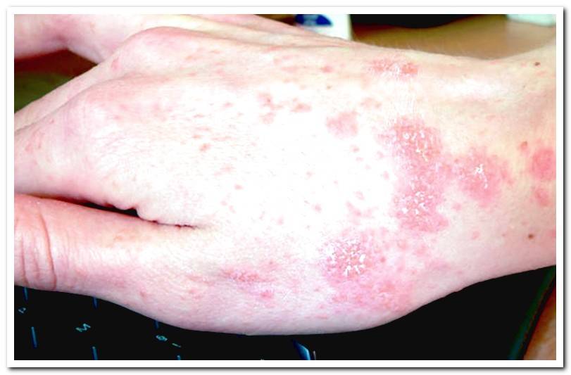 human-with-scabies-symptoms